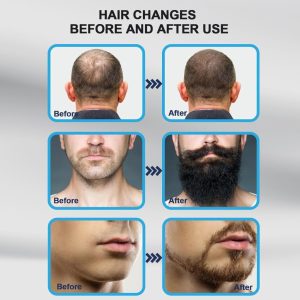 140 Titanium Adjustable Microneedling Derma Microneedle Stamp for Face, Hair, Beard & Scalp | Professional Skin Repair Pen | Reusable Dermastamp for Body & Home Use (Hair & Beard Growth)